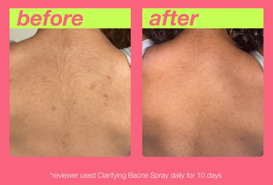 DERMALOGICA - CLARIFYING BACNE SPRAY