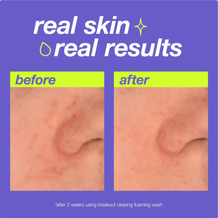 DERMALOGICA CLEAR START - Nettoyant mousseux anti-imperfections